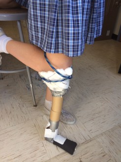 Prosthetic Side View